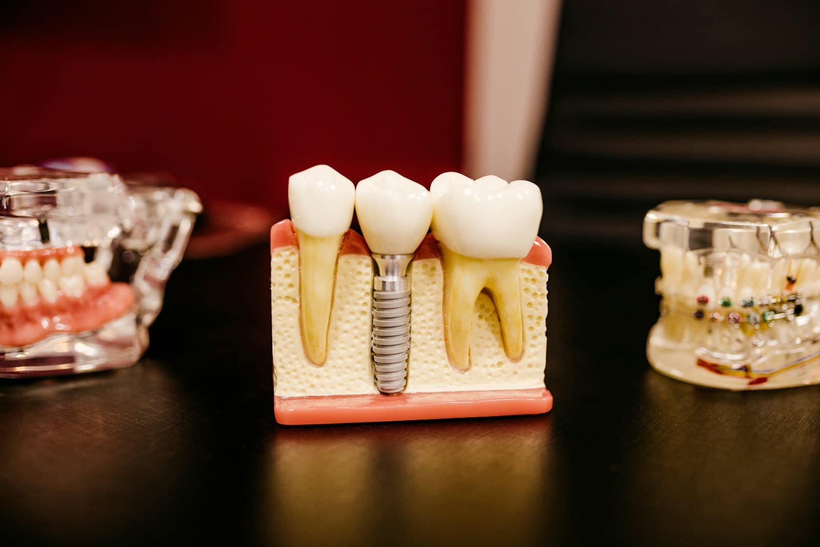 A dental model showing an implant post set in the jaw between natural teeth